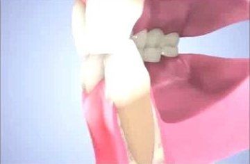 Curettaggio