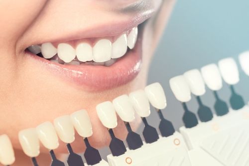 SBIANCAMENTO DENTALE
