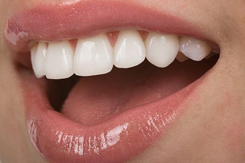 veneers