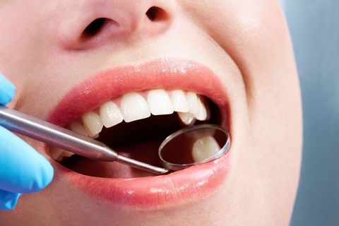tooth filling