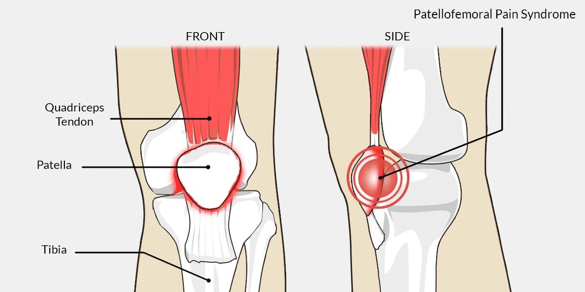 Illustration showing front and side views of the knee highlighting Patellofemoral Pain Syndrome.