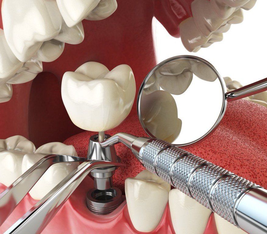 Dental Implant Tonawanda, NY