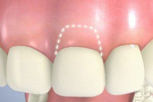 Crown lengthening illustration