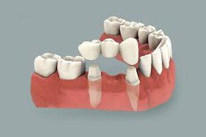 Dental Bridge Illustration