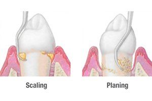 Occlusal Adjustment