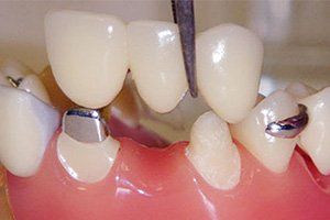 Dental Bridge