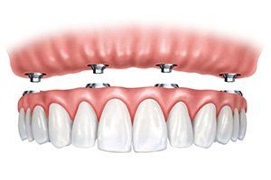 Illustration of Dentures