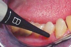 diagnodent been applied on tooth