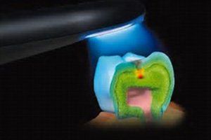 Diagnodent - tooth illustration