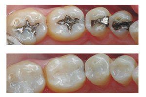 Tooth Colored Fillings