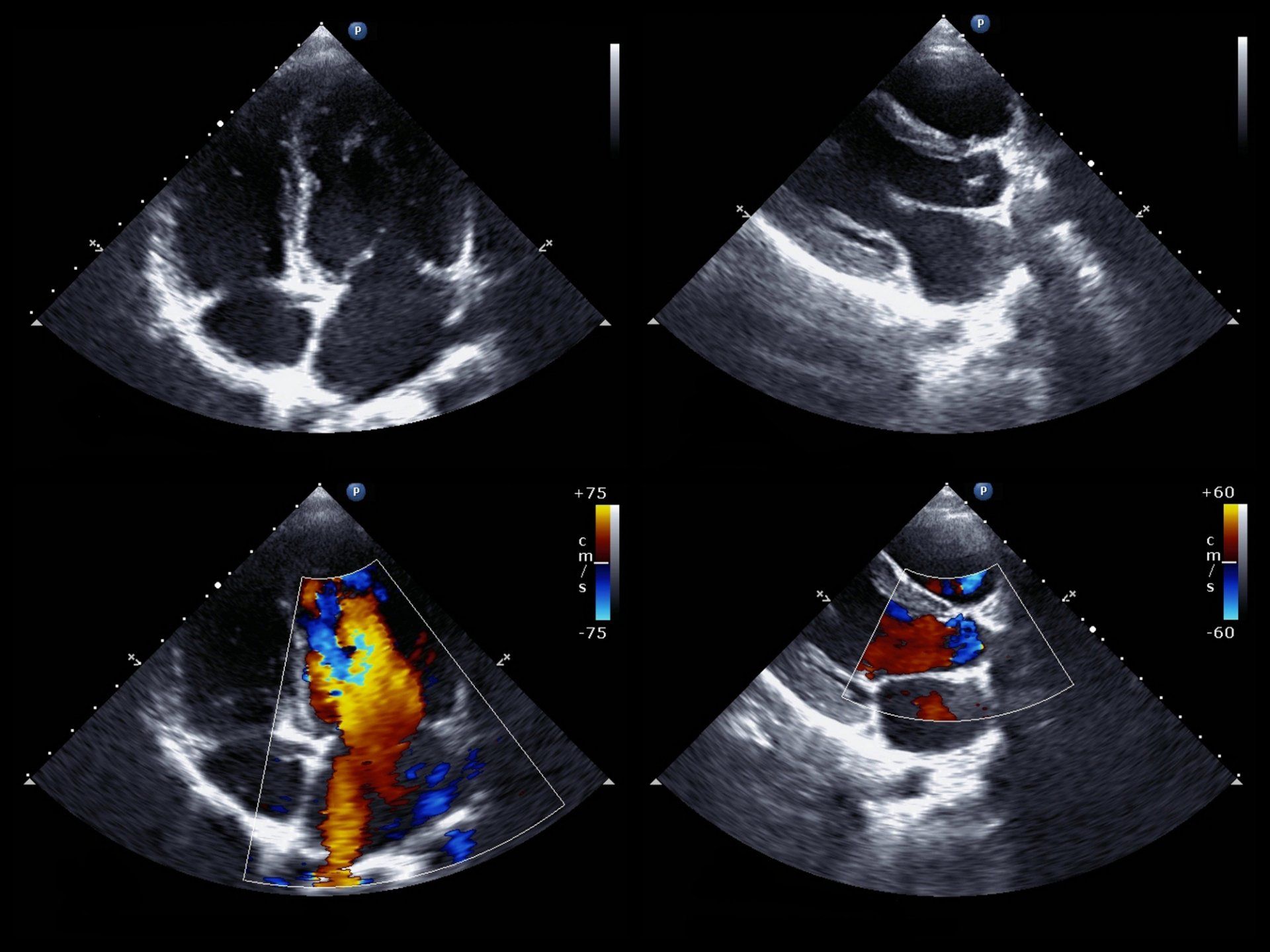 Echocardiogram: Four views of a heart. Two show chambers. Two with color Doppler show blood flow and regurgitation.
