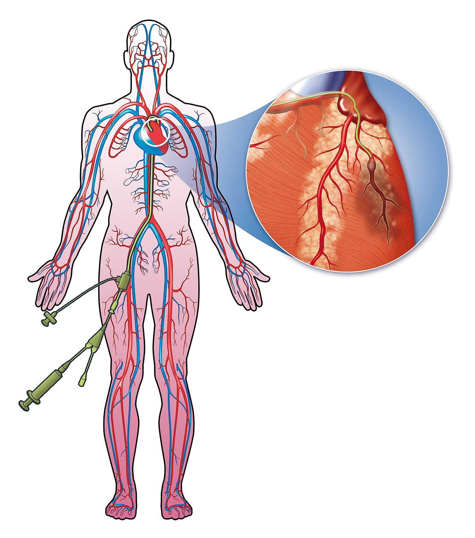 Diagram showing a catheter procedure entering the leg with an inset of a damaged heart.