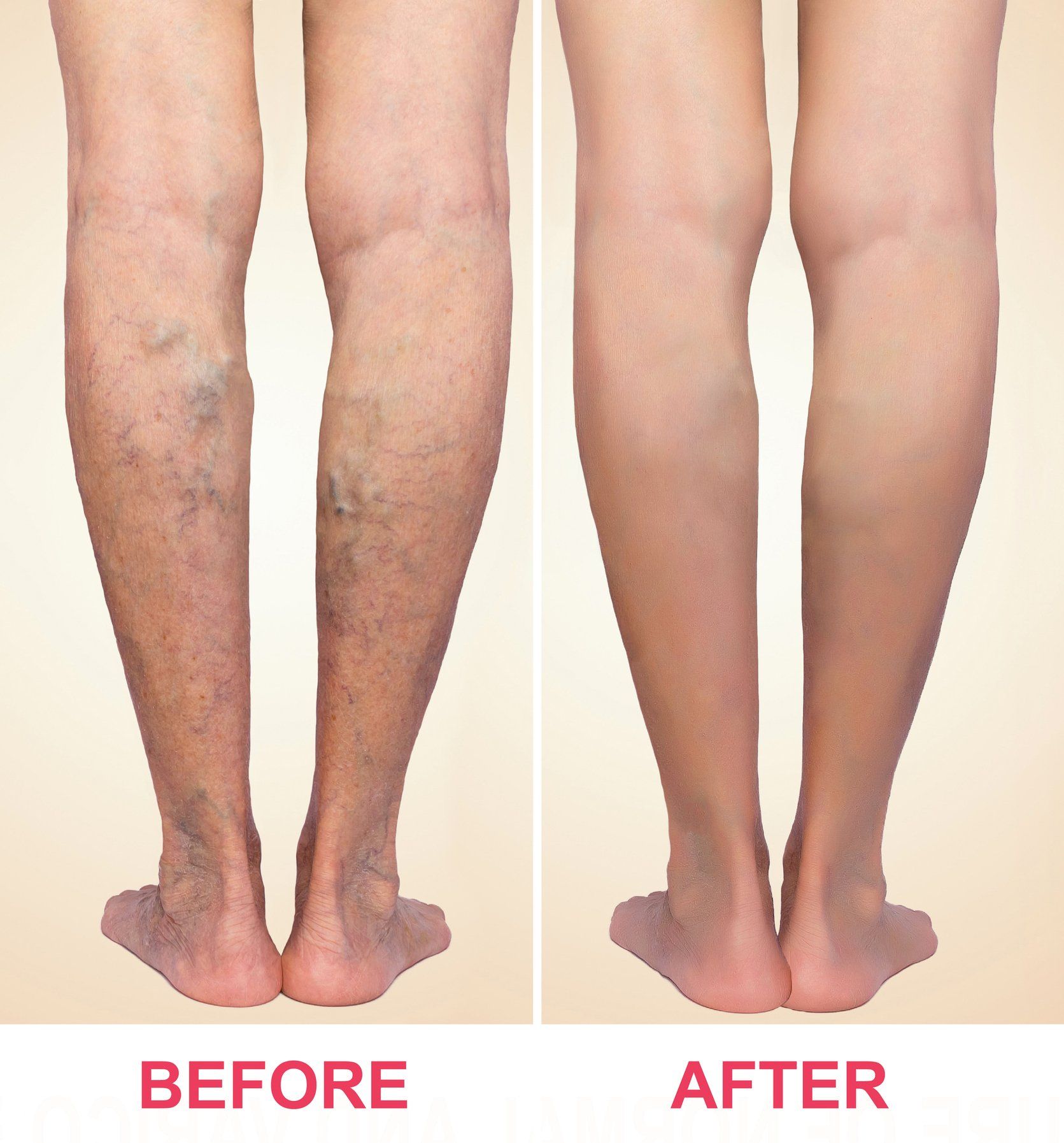 Legs before and after varicose vein treatment; discolored veins on the