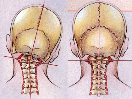 Upper cervical care and the Blaire Technique at Stone Chiropractic in Mount Pleasant, SC