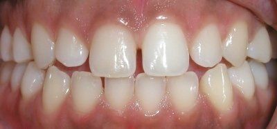 Albuquerque Dental — Without Veneers in Albuquerque, NM
