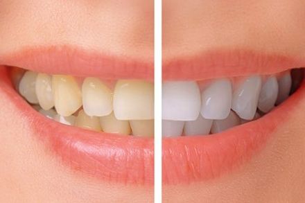 Before and After Dental - Dr. Jack Bernardo Jr. in Montgomery WV Before and After Dental - Dr. Jack Bernardo Jr. in Montgomery WV