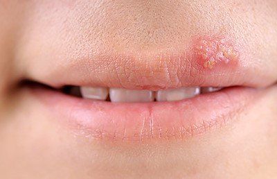 cold sores