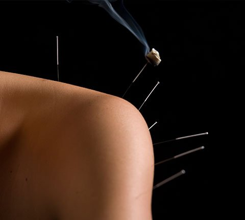 accupuncture in action