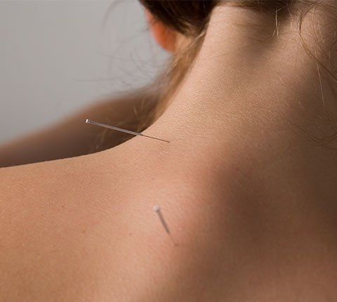 acupuncture