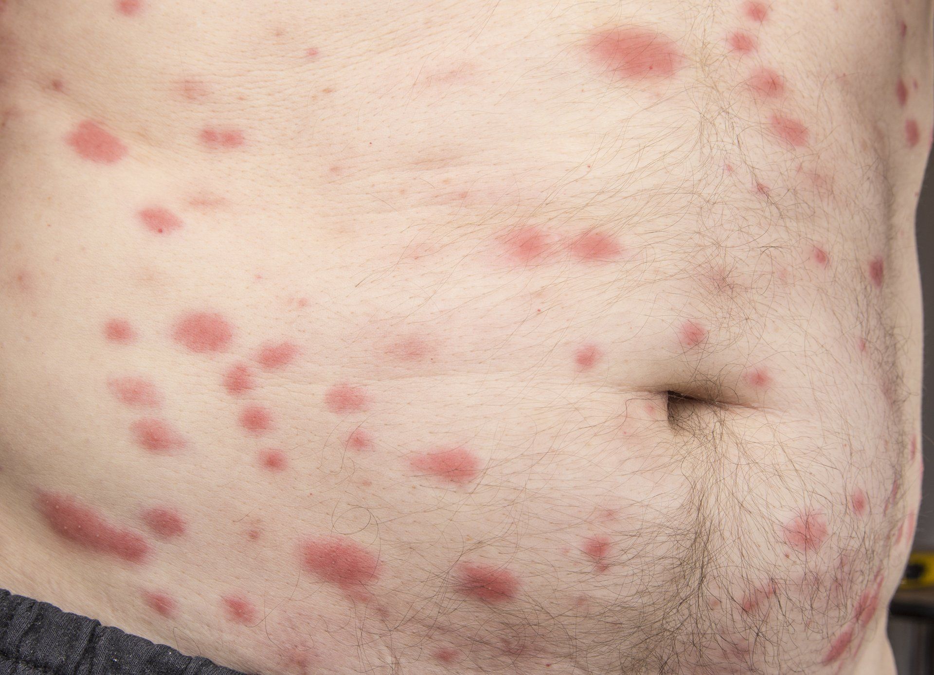 bed bug bites