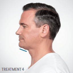 Side profile of a man's neck with a treatment line drawn, representing a cosmetic procedure.
