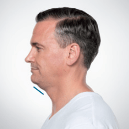 Man's profile, emphasizing his neck. A blue line indicates a treatment area for double chin.