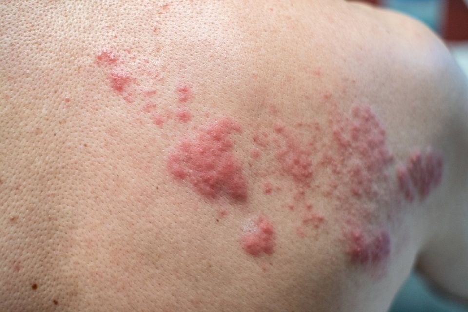 Rosacea — Metairie, LA — Dr. Carter D. Paddock Rosacea — Metairie, LA — Dr. Carter D. Paddock