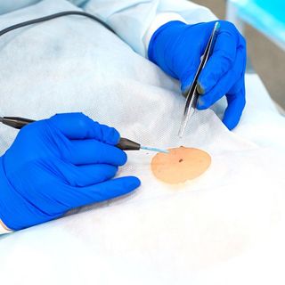 Mole Removal — Metairie, LA — Dr. Carter D. Paddock