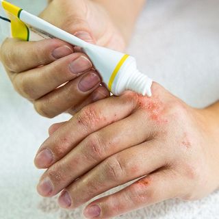 Eczema Treatment — Metairie, LA — Dr. Carter D. Paddock