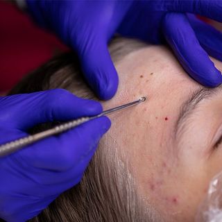 Acne Treatment — Metairie, LA — Dr. Carter D. Paddock