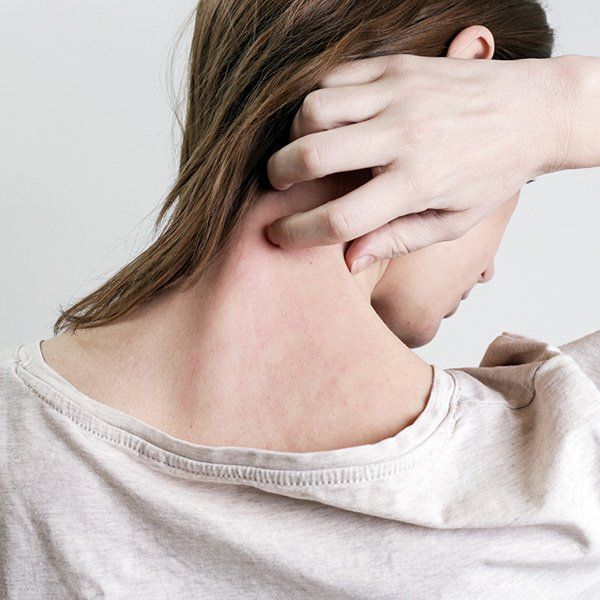 Eczema โ Metairie, LA โ Dr. Carter D. Paddock