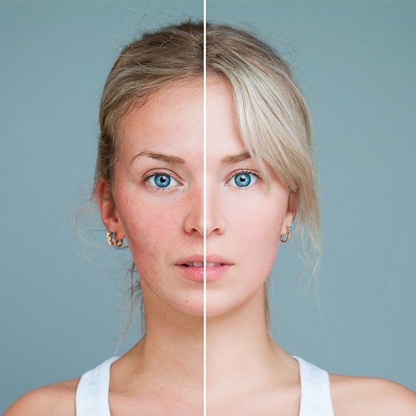 Rosacea — Metairie, LA — Dr. Carter D. Paddock Rosacea — Metairie, LA — Dr. Carter D. Paddock