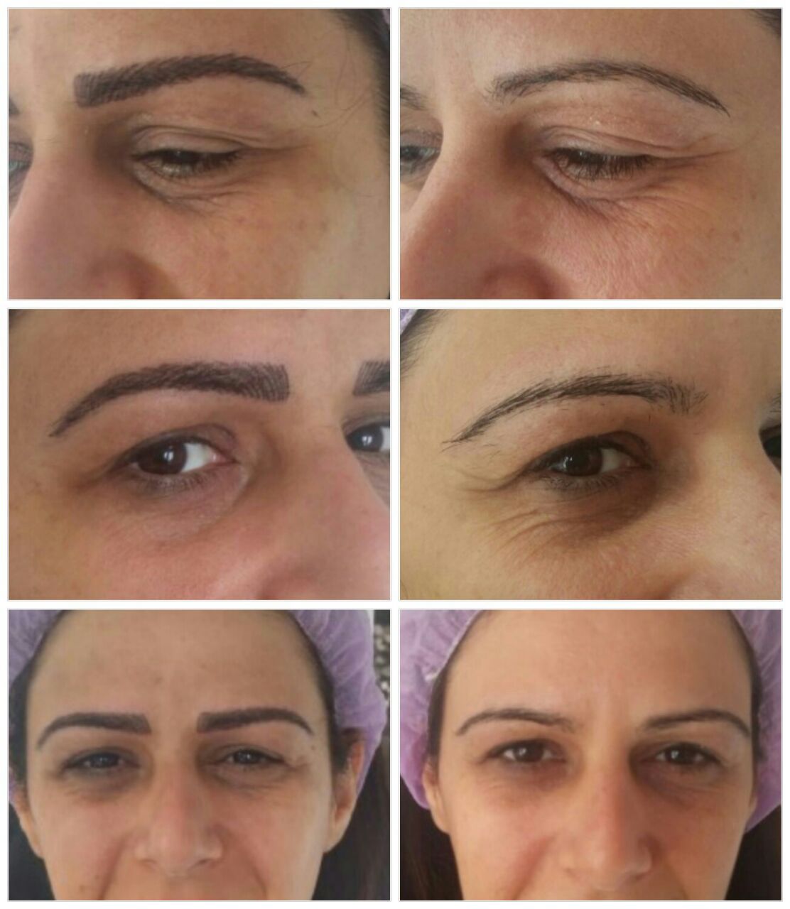 Before-and-after close-up collage of eyebrows and eyes showing cosmetic treatment results.