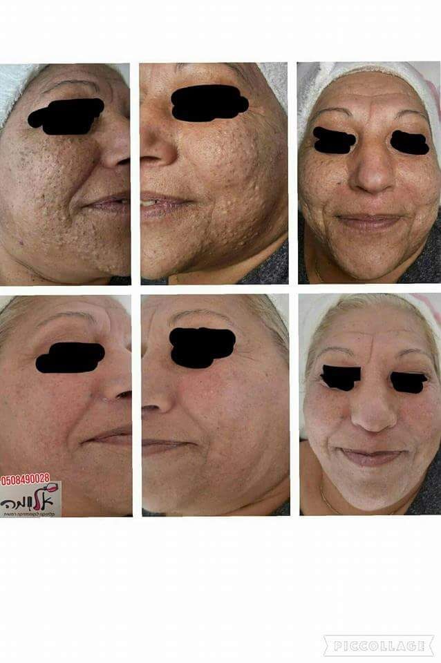 Collage of a woman’s face before and after surgery, with closed eyes in the final images