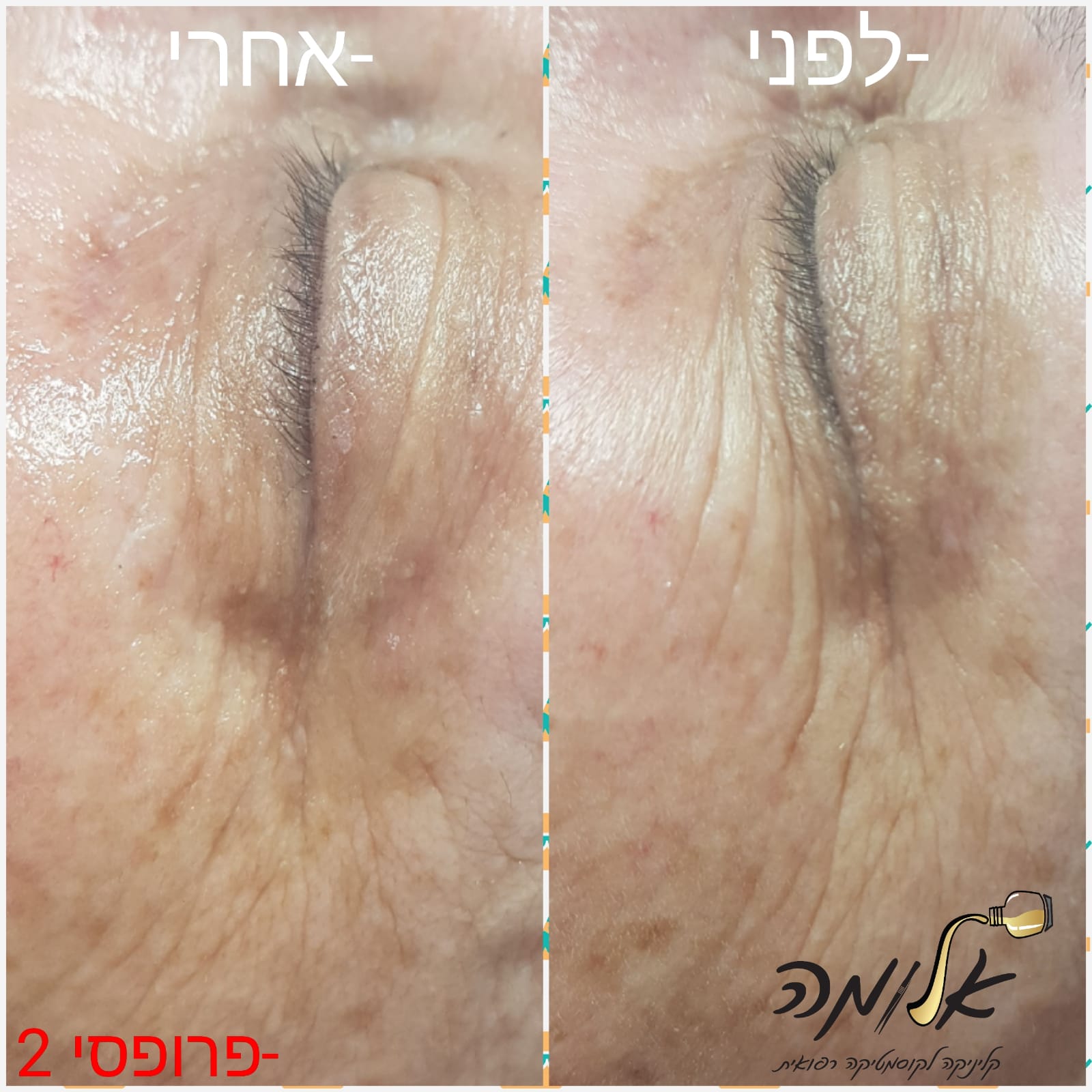 Split close-up of skin before and after a makeup line fix, labeled in Hebrew 