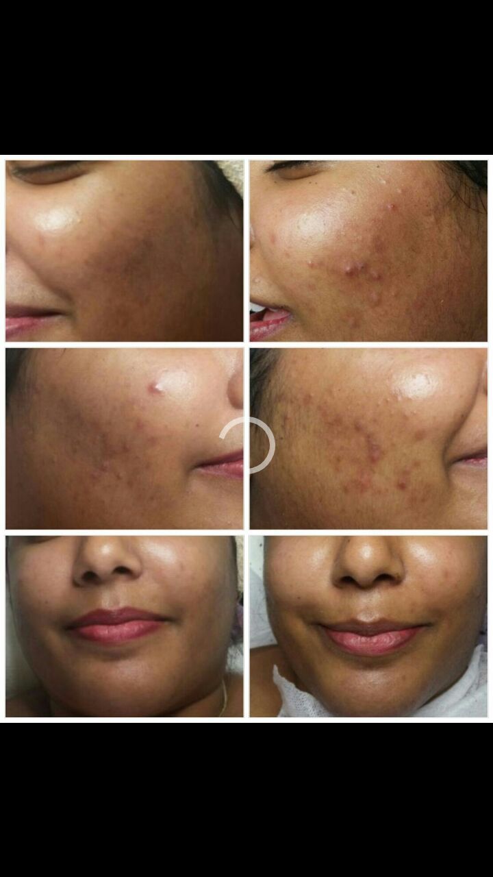 Six-panel collage showing facial skin with acne spots and clearer skin after treatment