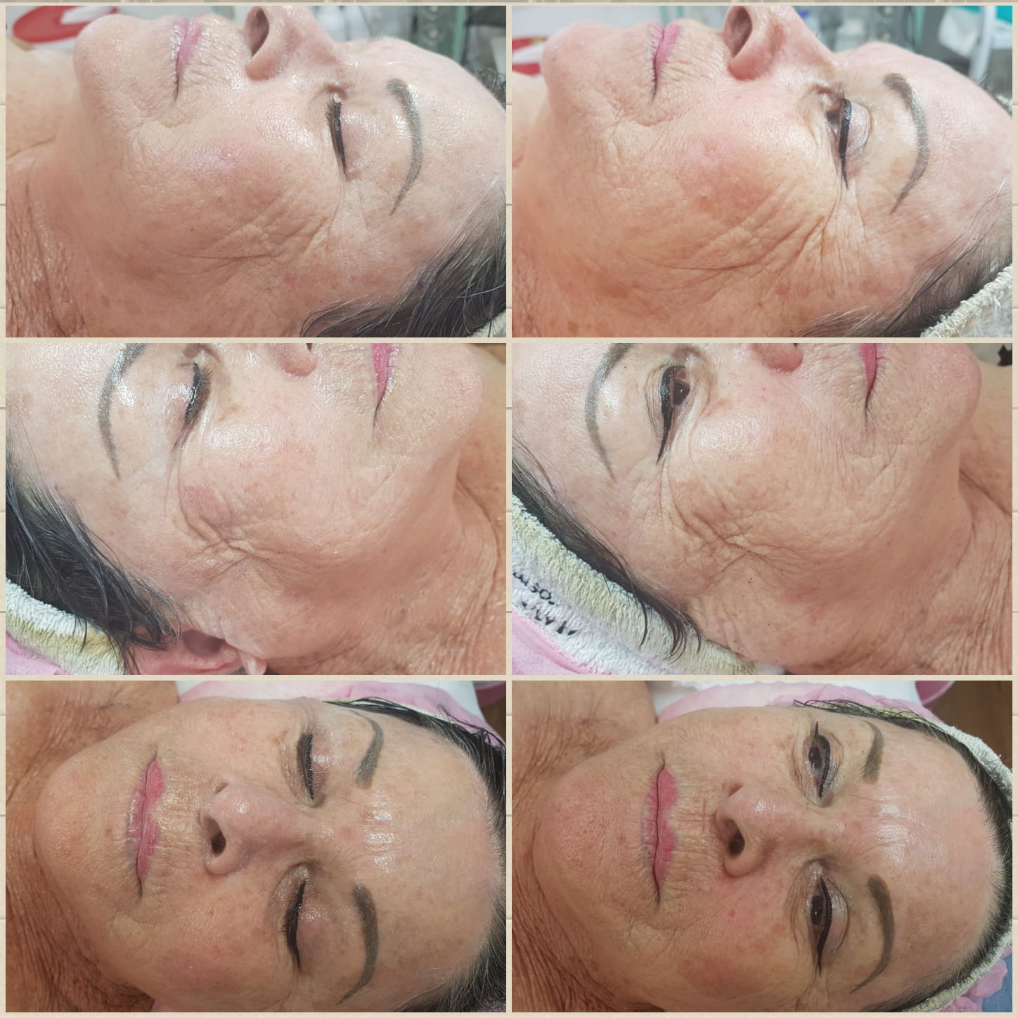 Collage of six close-up facial photos showing a skincare treatment with redness and swelling on the face