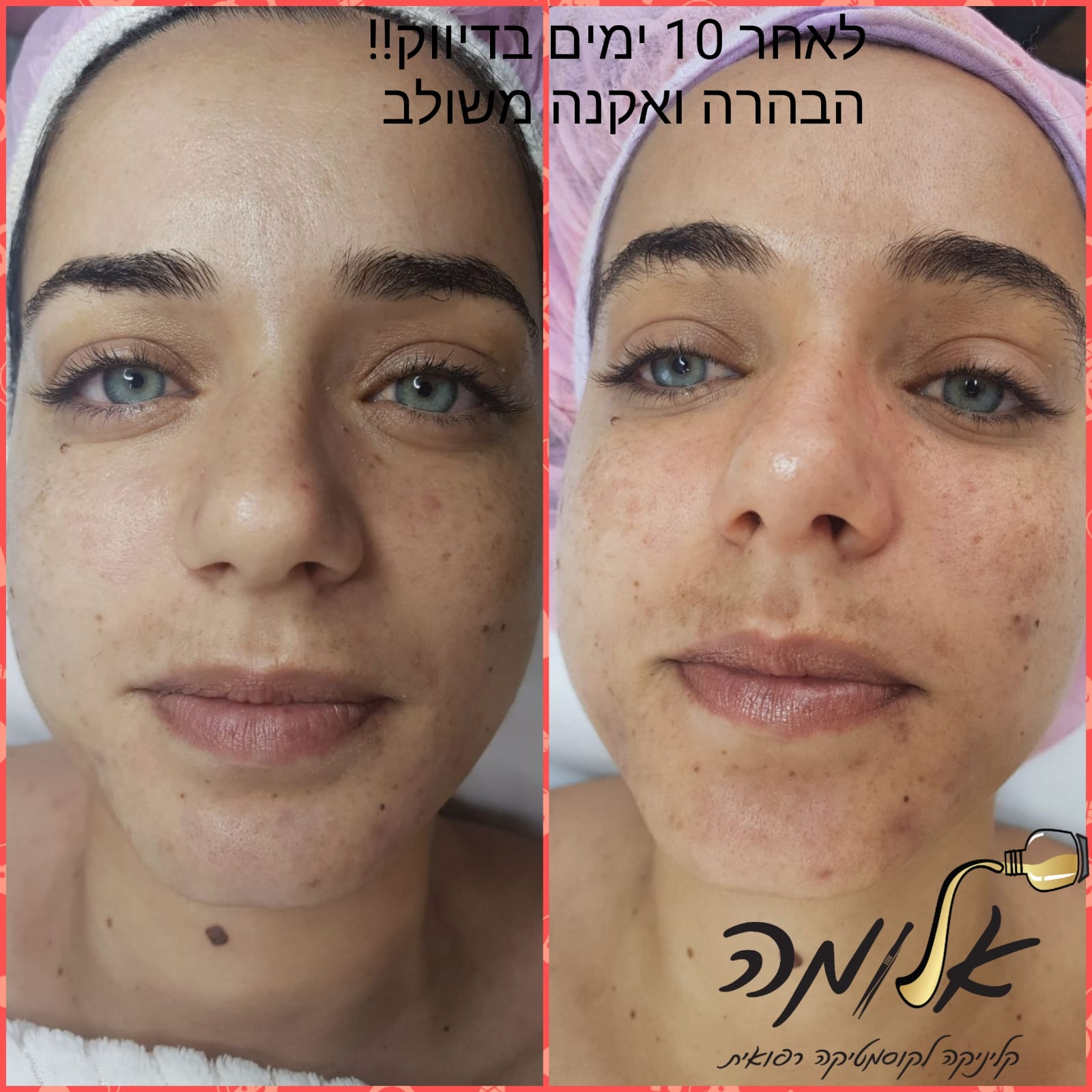 Side-by-side face photos showing skin improvement after 10 days of natural treatment, with Hebrew text overlay.