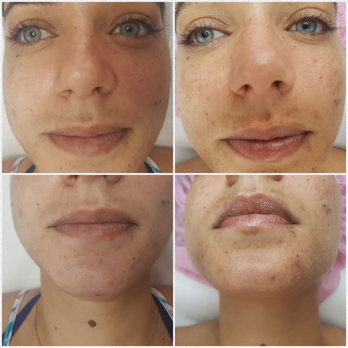 Four close-up facial photos showing acne and skin blemishes from different angles.