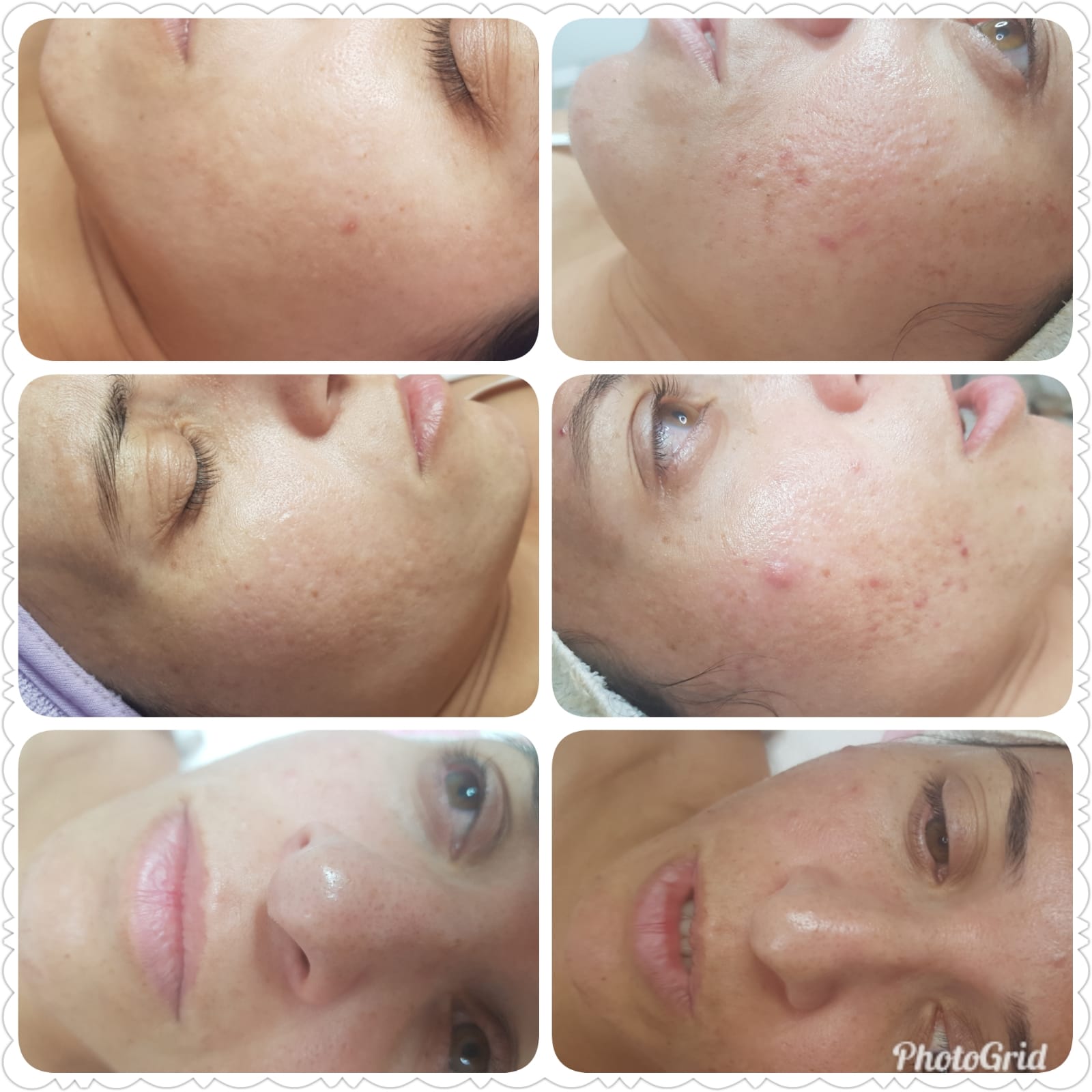 Six-panel close-up collage of a face, showing skin and cheek closeups with acne and blemishes.