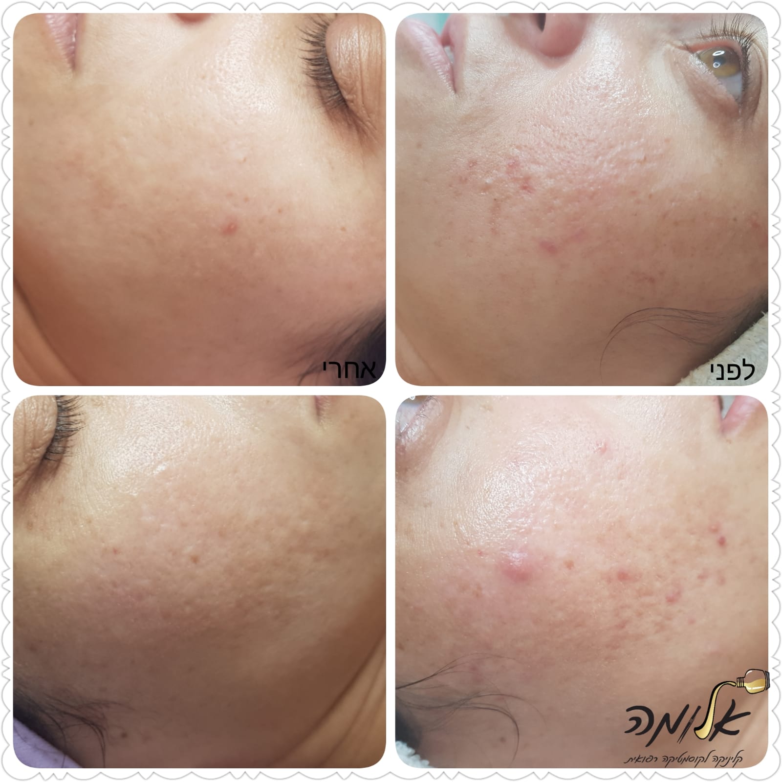 Four close-up facial skin photos showing acne and redness on the cheek and jawline.