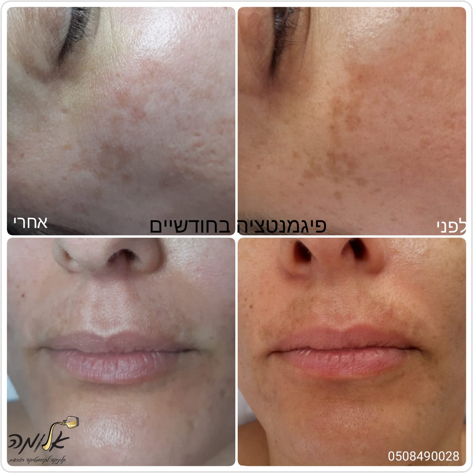 Before-and-after close-ups of facial skin with reduced dark spots and smoother complexion.