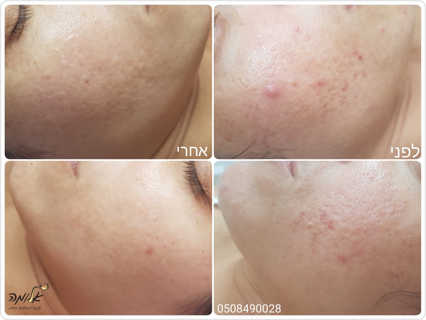 Four close-up cheek photos showing facial acne and skin texture before-and-after comparison