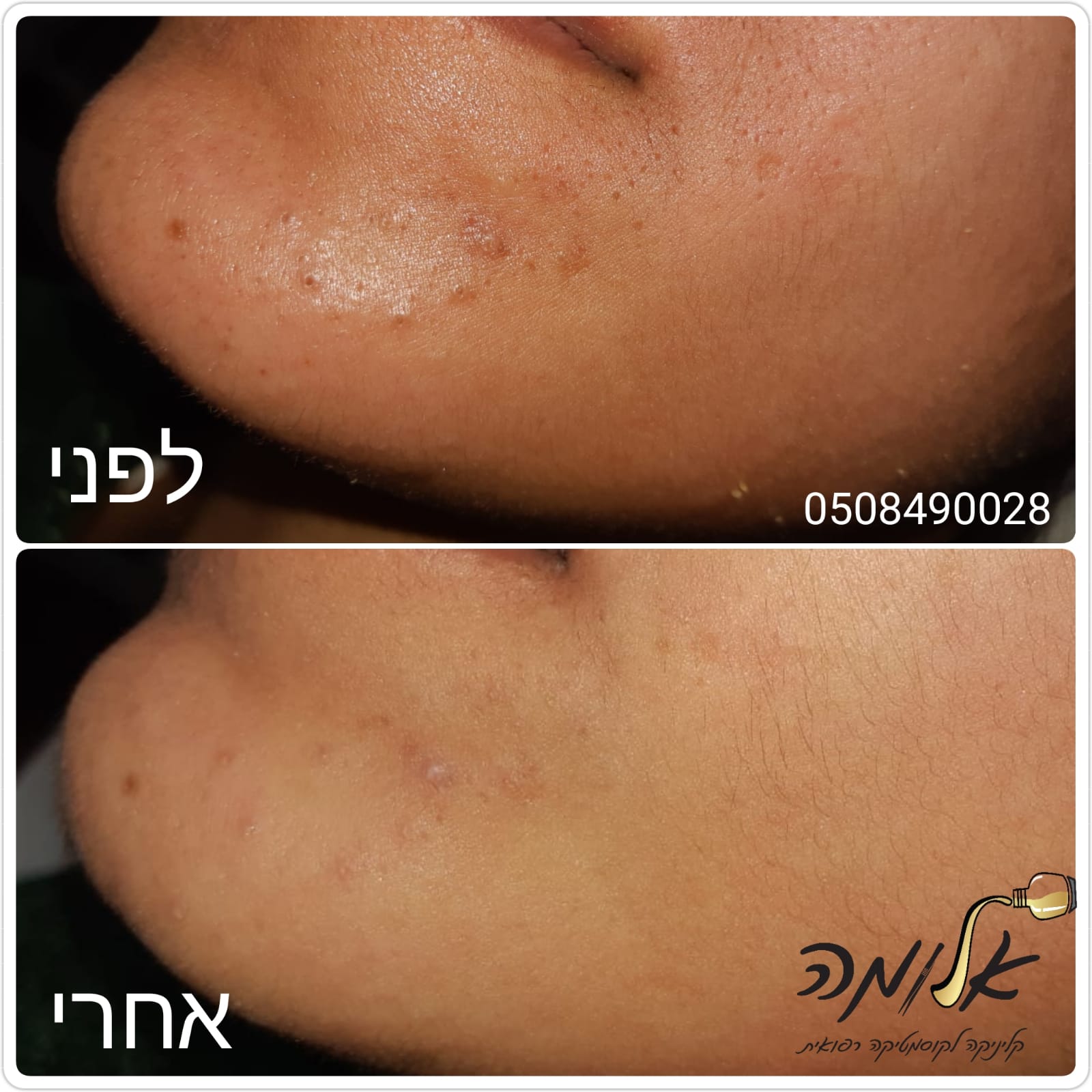 Close-up of cheek skin before and after treatment, showing reduced blemishes and smoother texture.