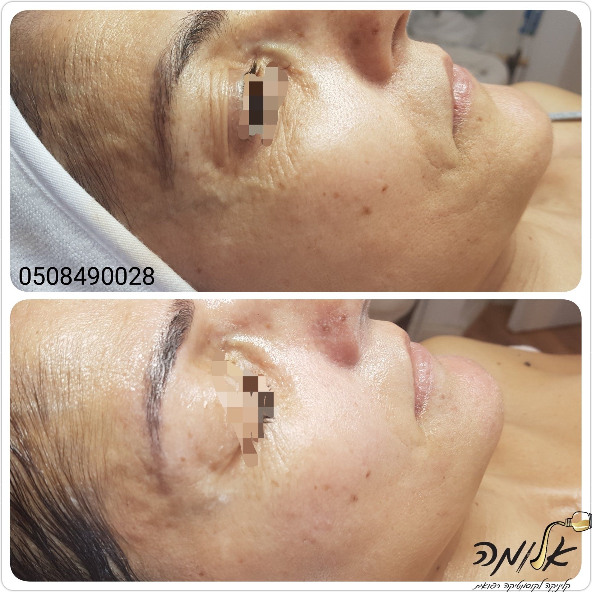 Side-by-side close-ups of a face with dark spots before and after treatment.