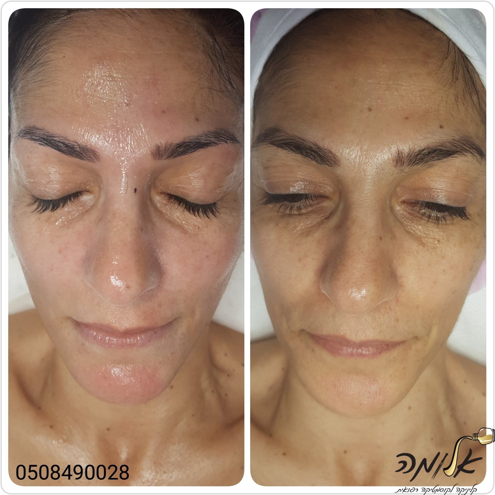 Side-by-side close-up of a face before and after treatment, showing reduced skin redness and shine