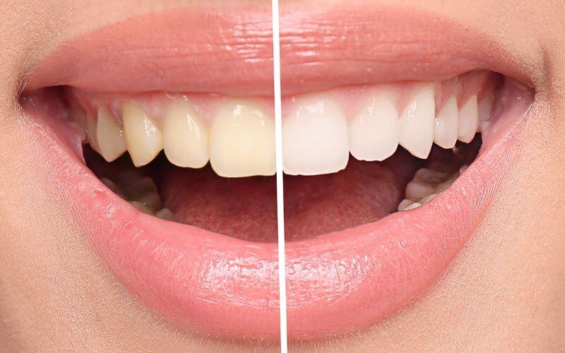 Beyond whitening system