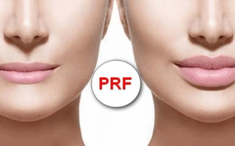 Facial skin regeneration method - iPRF procedure