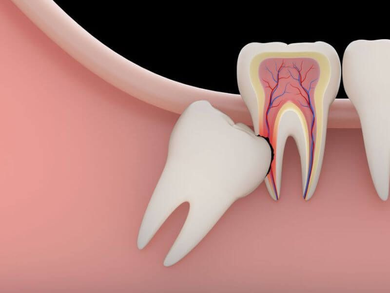 All kinds of tooth extractions