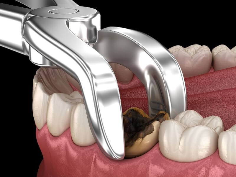 All kinds of tooth extractions